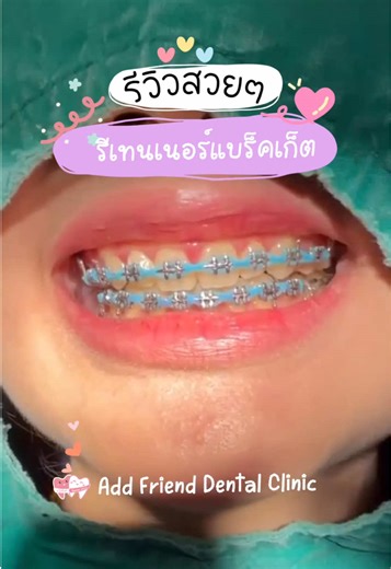🍒โปรรีเทนเนอร์แบร็คเก็ต 🍒 🎉 4,200.-/2ชิ้น 🍓จัดฟันที่อื่นก็ทำรีที่เราได้ 🍓ถอดเครื่องมือจากที่อื่น 1,333.- ✨ฟรีพิมพ์ฟัน ✨ฟรีใส่ Glitter 🦷เติมฟันซี่ละ 300 🌈สนใจติดต่อได้ที่ Add Friend Dental Clinic ทั้ง 4 สาขา -สาขาพญาไท -สาขาราชพฤกษ์ -สาขาท่าพระ -สาขาศาลายา #คลินิกทันตกรรม #รีเทนเนอร์ #รีเทนเนอร์แบร็คเก็ต #รีเทนเนอร์เปลี่ยนยาง #รีเทนเนอร์ไร้เหงือก