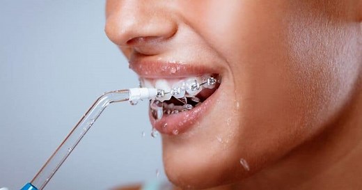 Best Waterpik Water Flossers for Braces: Which One Works Best?