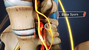 706 reactions · 992 shares | Our new video short can help you understand how bone spurs impact the nerves of your spinal column when living with lumbar spinal stenosis. Take a look: | Spine-health | Facebook