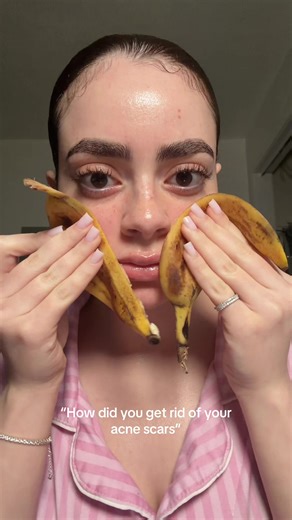 Bannana peel for acne scars #skincaretips #fyp | skin care tips