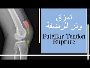 تمزق وتر الرضفة - قطع الوتر الرضفي - الم الركبة الامامي Patellar Tendon Rupture بالعربي