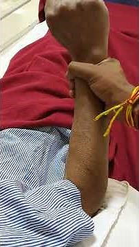 Lead pipe rigidity in a patient of Parkinson's disease