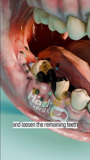 Dental Implant Explained?