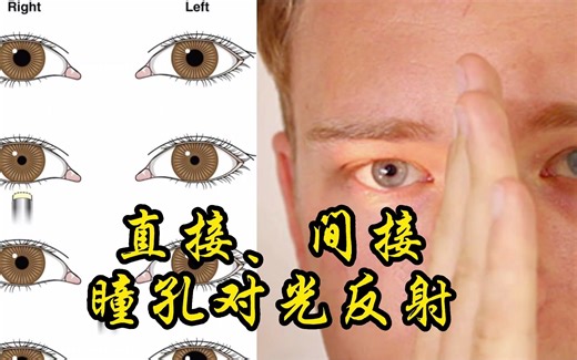 直接和间接瞳孔对光反射