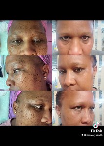 2.1K views · 42 reactions | DPN removal, watch till the end for her...