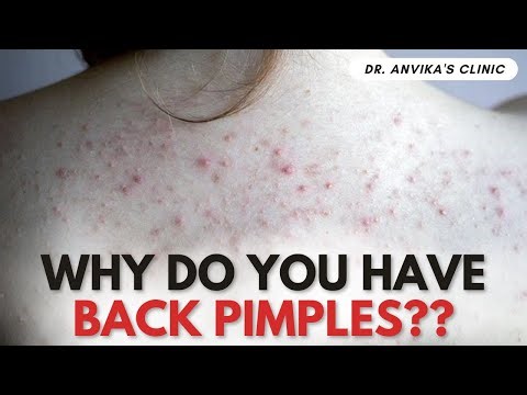 How To Remove Back Pimple Fast || Causes Of Back Pimple and Treatment || Dr Anvika Mittal