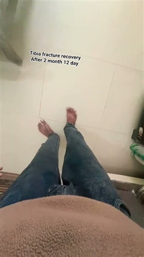 2 months 12 day recovery after tibia nd fibula sergery #sergery#tibia#fibula