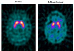 Parkinson / Ziekte info | neurologen-alrijne