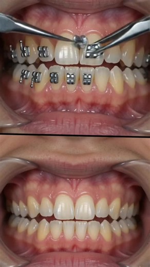 Orthodontic Bracket Placement: How to Place Braces Precisely