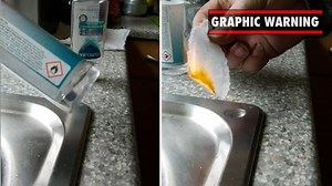 Hand sanitiser could cause painful burns if used incorrectly