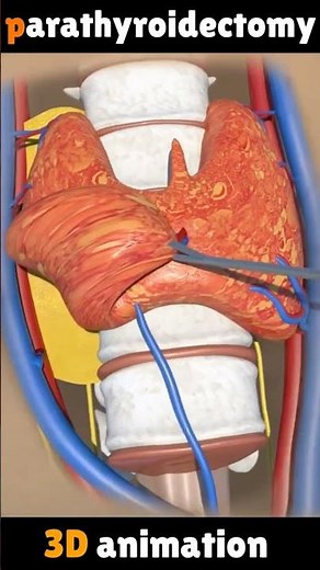 Parathyroidectomy 3D animation | medical ads | medical