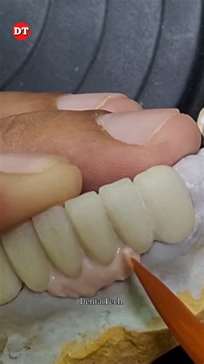 ceramic layering|| gingiva build up| Dental lab| anterior Ceramic| anatomy| dental technician video