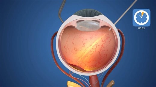 Tiny eye implant can help patients see again