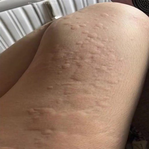 Dacă îți apare asta pe piele, este unul dintre semnele de hi... Vezi mai mult | România