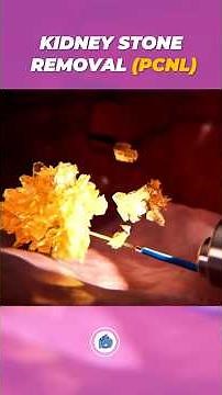 Kidney Stones Removal PCNL | 3D Animation | Percutaneous Nephrolithotomy Explained #doctor3d #facts