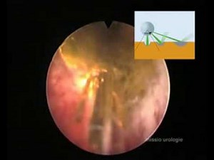 HPS Green Light Laser Teil 1