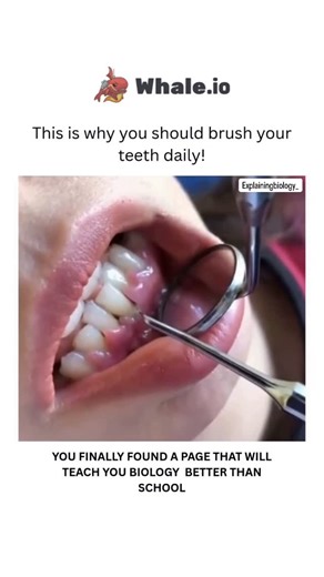 BIOLOGY | MEDICAL | HEALTH on Instagram: "When you don’t brush regularly, plaque builds up on your teeth, which can lead to periodontitis, a serious gum infection that damages the soft tissue and bone supporting your teeth. Here’s how it happens: Step 1: Plaque Buildup When teeth aren’t brushed regularly, plaque (a sticky film of bacteria) forms on teeth. Step 2: Tartar Formation If plaque isn’t removed, it hardens into tartar (calculus), which can only be removed by a dental professional. Step 