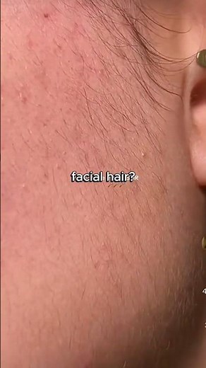 Remove Facial Hair Naturally at Home | Easy DIY Facial Hair Removal Recipe #hair #skincare #facial