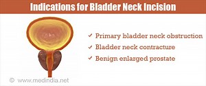 Bladder Neck Incision - Indications, Types and Complications