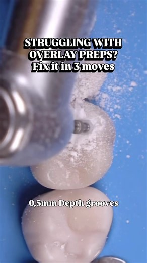 Quick Overlay Prep Process for Dental Professionals