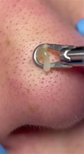 Massive Blackhead Extractions 😱 Deep Facial Treatment