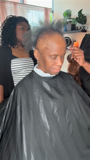 3.3K views · 935 reactions | Alopecia and other types of hair loss...