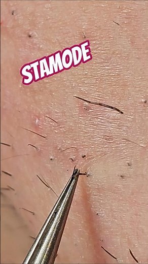 Extreme Close-Up: A Perfectly Clean Pull 🧔 #beard #tweezing #plucking
