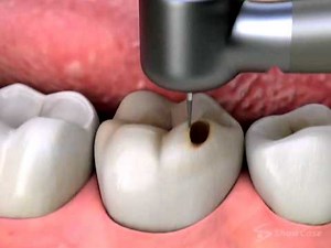 Inlay & Onlay Restoration - Fort Lauderdale, FL