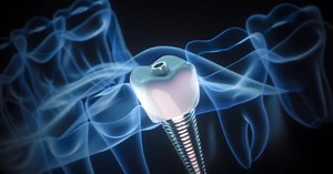3D Medical Animation of Dental Implant Procedure