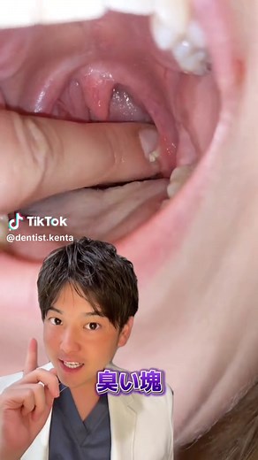 臭い玉について説明します🙋‍♂️ ↓ 臭い玉は「においだま」とも「くさいだま」とも読まれます。 扁桃の表面にはたくさんの凹凸があり、そのくぼみは扁桃の実質内に深く入り込んでいます。 このくぼみを陰窩と呼び、陰窩は扁桃の表面に無数に存在しています。扁桃は陰窩があるために、扁桃全体としての表面積が大きくなっており、細菌をより効率的に退治できる構造になっています。 臭い玉の正体は「膿栓」というもので、扁桃の陰窩に溜まった白っぽい塊になります。 お口の中の清掃や細菌の抑制に重要な役割を果たしている唾液の分泌が少ない人やクセで口呼吸をする人は、口内が乾燥しやすいため、細菌の増殖や膿栓の発生が促進される可能性があります。 最後まで読んでくださりありがとうございました😊 #歯医者 #おすすめ #臭い玉