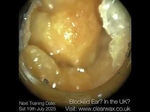 327 - Crusted Dry & Hard Ear Wax Removal using the #WAXscope®️