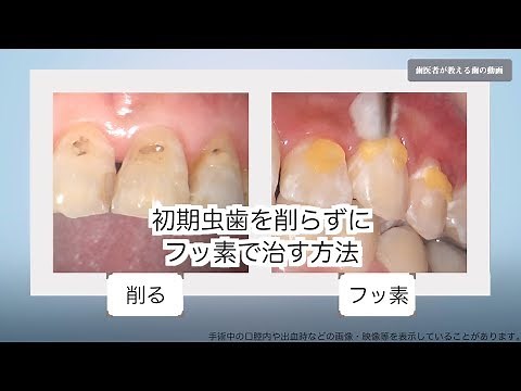 初期虫歯を削らずにフッ素で治す方法