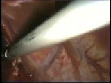 Conversion of Nissen Fundoplication to Cardiomyotomy & Toupet - Laparoscopy • Video • MEDtube.net