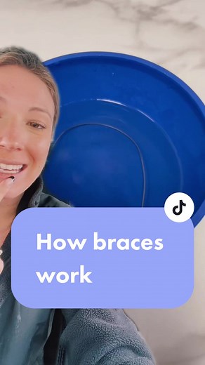 Heat Activated Braces: How They Work