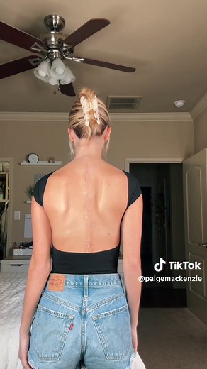 6 Weeks Post Surgery Recovery Update - Paige Mackenzie TikTok
