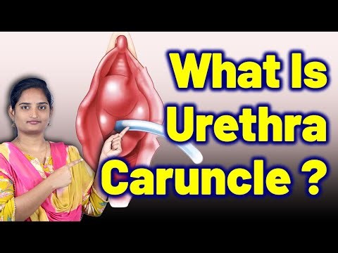 What Exactly Is Urethra Caruncle, Urethral Lump, Urethral Growth | Treatment Cure | Gynaecology