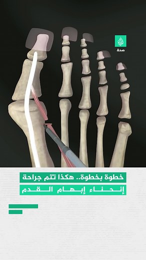 جراحة إنحناء إبهام القدم: تعرف على العملية الجراحية والأعراض