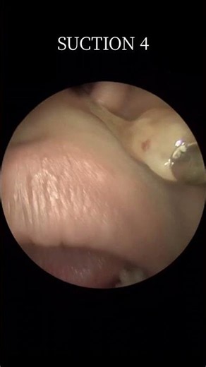 @귀지형 #콧물 #부비동염 #축농증 #비염 #코청소 #이비인후과 #rhinorrhea #rhinitis #sinusitis #asmr #ENT #ENTdoctor