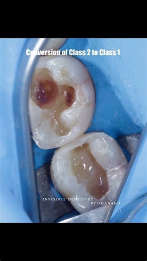 What looked like a simple Class 1 on tooth 37 turned out to hide adjacent Class 2 defects.