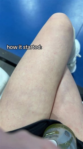 My Journey with Tonsillitis: From Start to Recovery