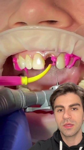 Fixing a Missing Tooth: Root Canal Procedure Explained