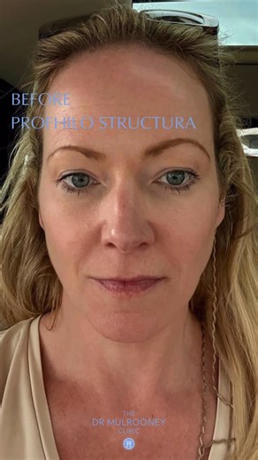Dr. Mulrooney Clinic on Instagram: "BEFORE & AFTER Profhilo® Structura Profhilo® Structura is a next-generation injectable bioremodeling treatment designed specifically to target age-related volume loss and skin sagging. Unlike traditional dermal fillers that primarily add volume by placing gel-like substances under the skin, Profhilo® Structura works by stimulating the body’s natural regeneration processes, particularly in the subcutaneous fat layer. Profhilo® Structura is an innovative injecta