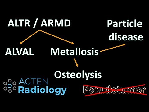 Hip Metallosis, Pseudotumor, ALVAL or ALTR or ARMD?