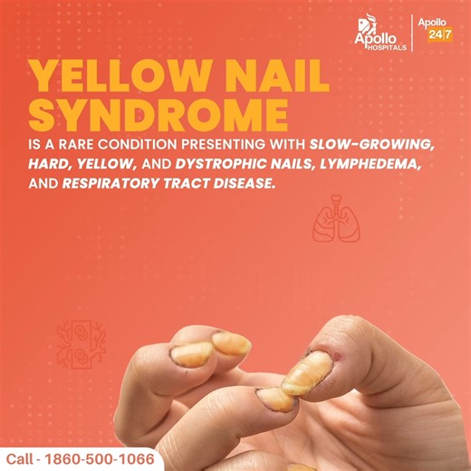 13 reactions | Yellow nail syndrome is rare and starts in middle age, although a similar condition has been described in younger children. Patients can get appropriate medical treatment for the respiratory symptoms and lymphoedema. Consult a doctor if you suspect having this disease. #ApolloHospitals #YellowNailSyndrome | Apollo Hospitals | Facebook