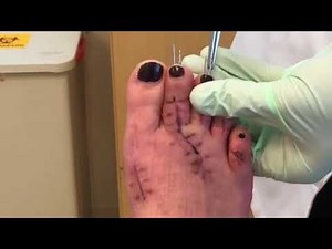 Toe Pin Removal 1-22-18