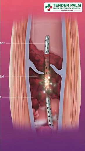 DVT Treatment: 5 Key Steps Every Patient Should Know