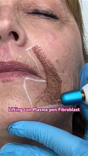 Lifting con Plasma pen Fibroblast.