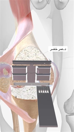 130K views · 348 reactions | عملية تبديل مفصل الركبة Total knee replacement #الدكتور_عمر_خضر #معلومات_طبية_يومية #شارك_المنشور_لكي_تعم_الفائدة | د.عمر خضر | Facebook