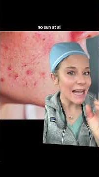 Dermatologist guide for preventing and treating post inflammatory erythema. 🎥 arianney #acnescars