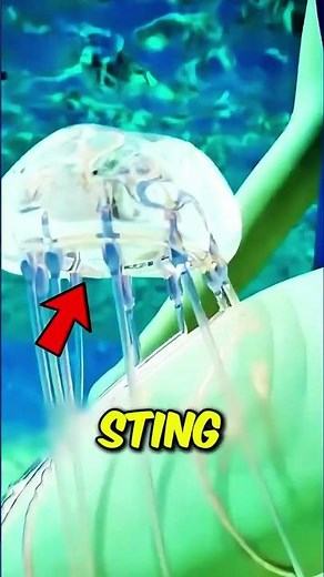 What Should You Do If a Jellyfish Stings You